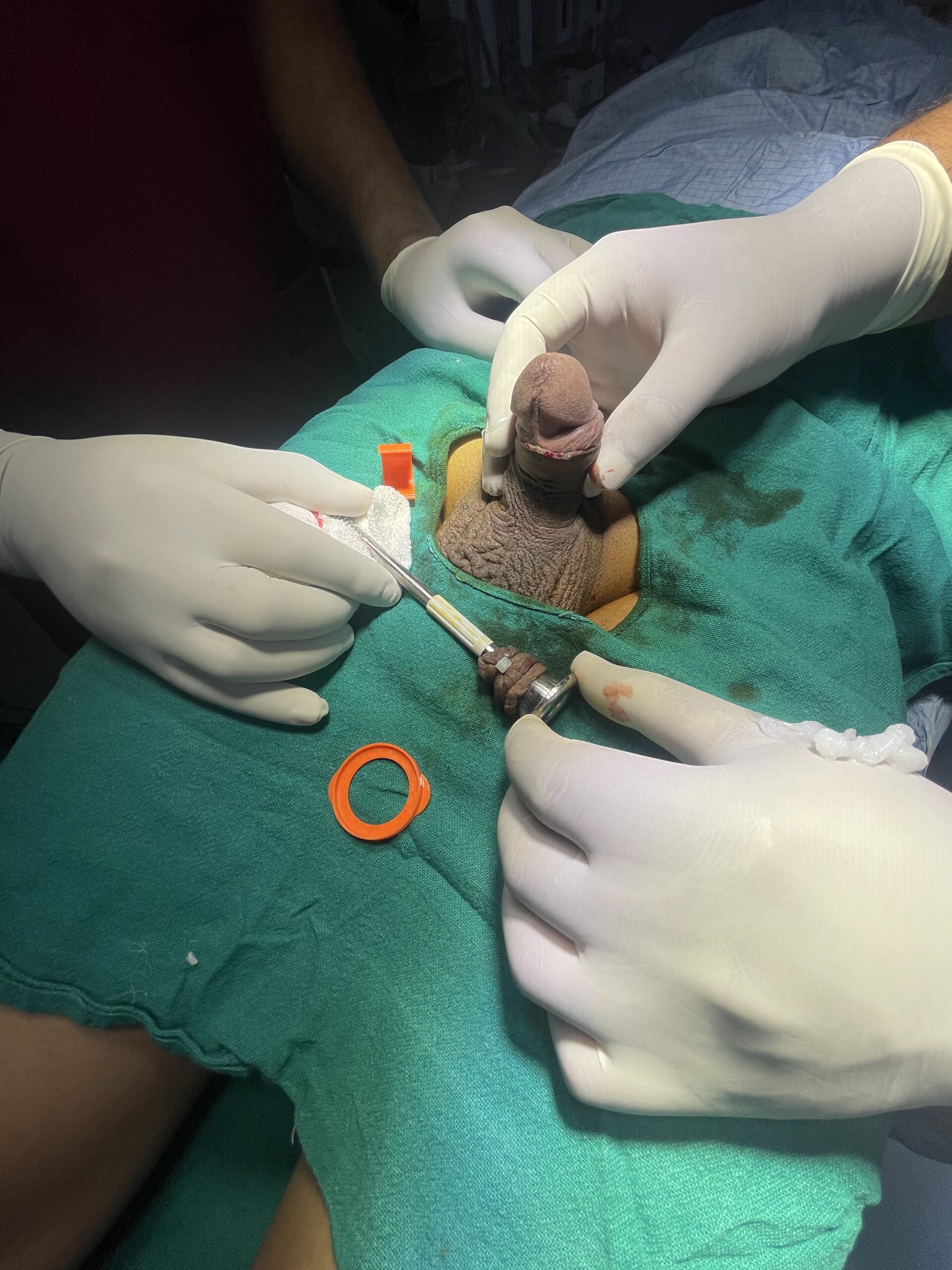 circumcision