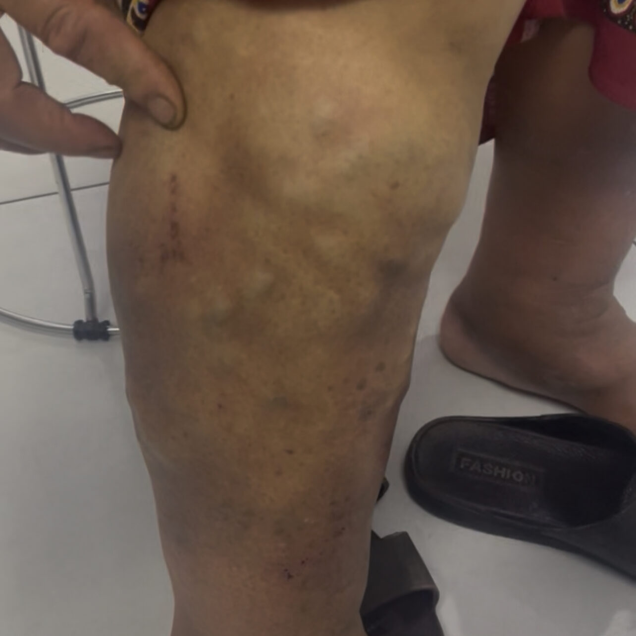 Modern Varicose Veins Treatment in Nepal: Minimally Invasive Laser Surgery by Expert Dr. Dinesh Chapagain