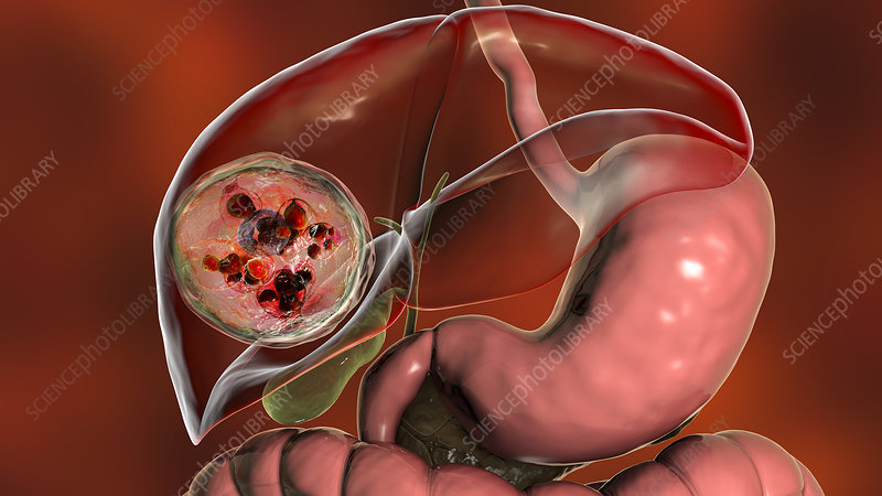Hydatid Cyst: Symptoms, Diagnosis, and Advanced Treatment in Nepal | Inova Hospital