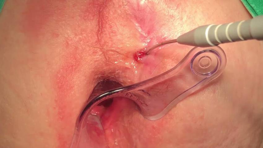Finding Relief from Fistula: Advanced Laser Surgery at Inova Hospital, Kathmandu by Dr. Jayant Sah