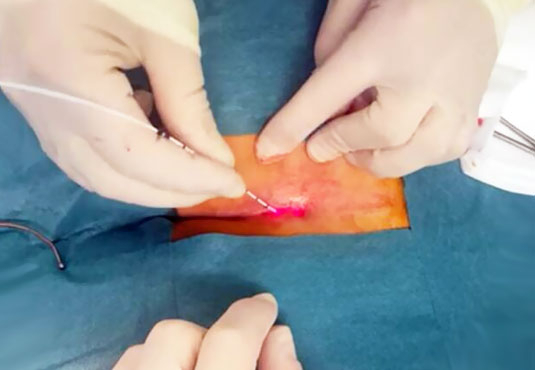 Permanent Relief from Pilonidal Sinus with Advanced Laser Surgery by Dr. Jayant Sah at Inova Hospital