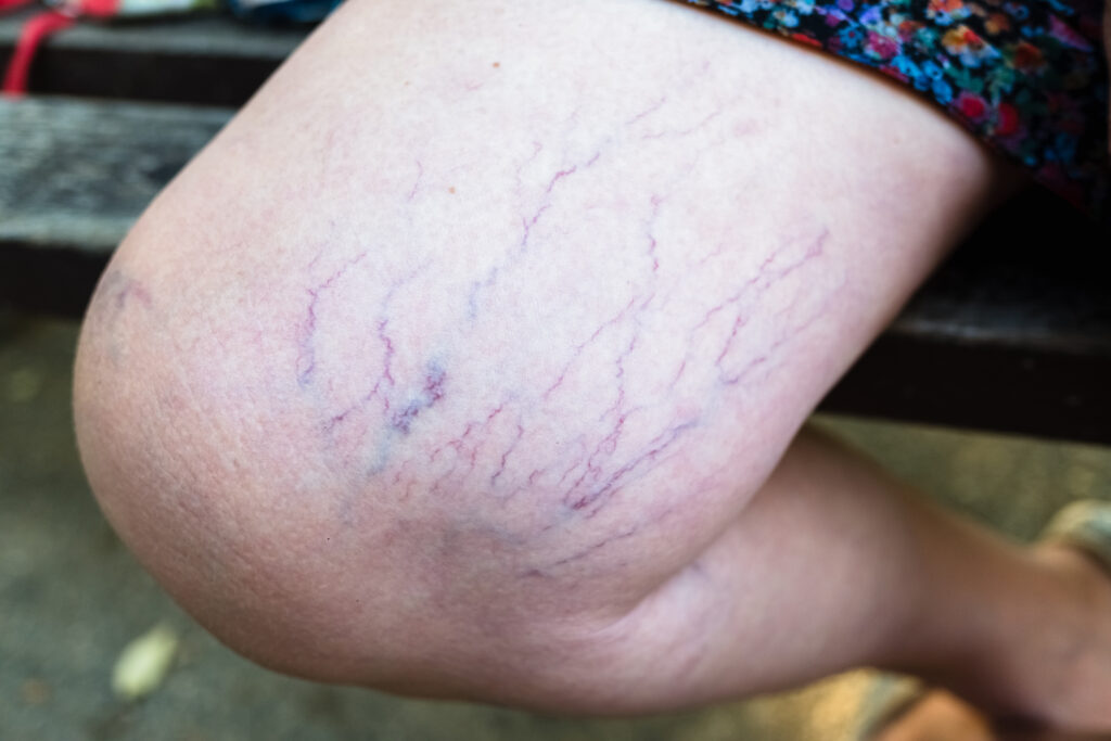 Advanced Spider Veins Treatment in Kathmandu: Laser Solutions by Prof. Dr. Dinesh Chapagain at Inova Hospital