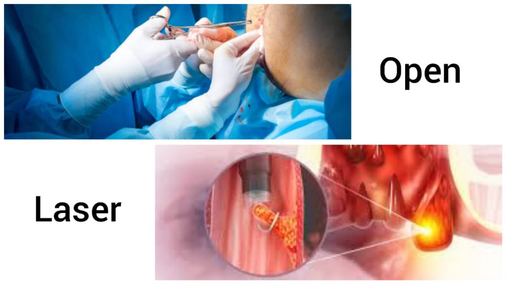 Laser vs. Open Surgery for Hemorrhoids: A Modern Comparison at Inova Hospital, Kathmandu