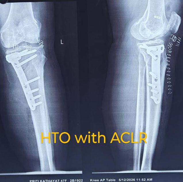 Post-operative X-ray of High Tibial Osteotomy and ACL Reconstruction by Dr. Sudip Khanal. Lateral view X-ray showing orthopedic hardware for HTO and ACLR at Inova Hospital.
